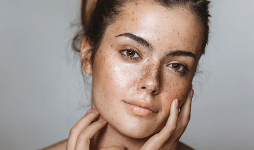 Hyperpigmentation – What are the causes of dark spots and how to reduce them?